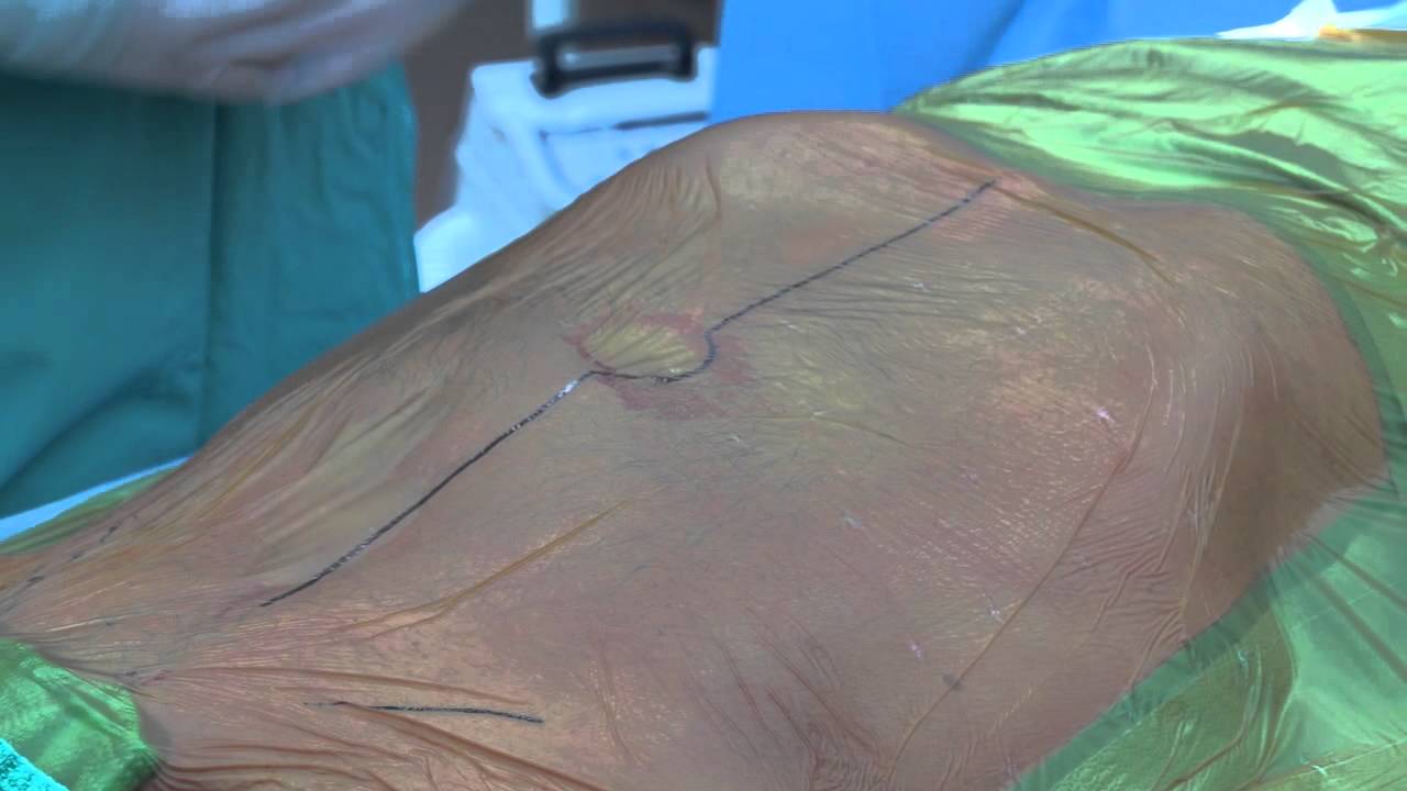 Minimally Invasive Vascular Surgery