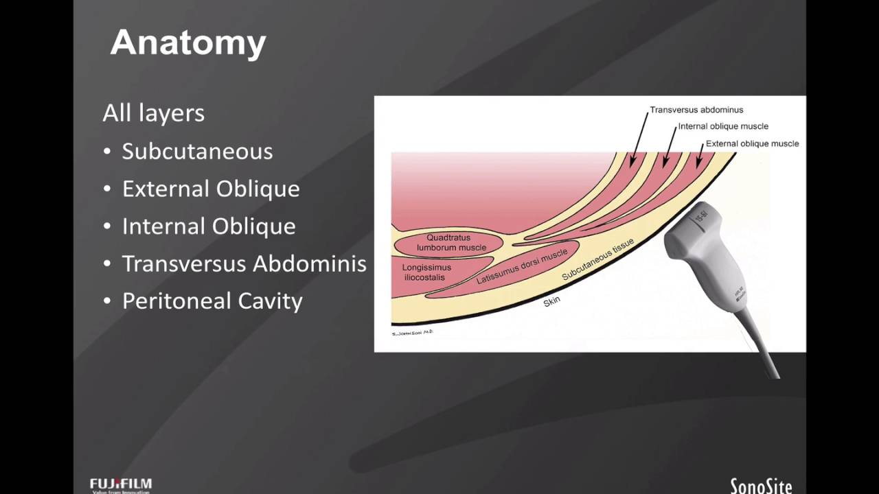 Webinar: Ultrasound-Guided TAP Blocks