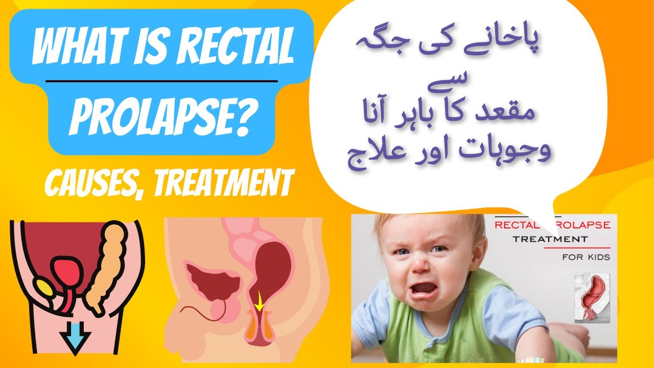 What is Rectal Prolapse?پاخانے کی جگہ سے مقعد کا باہر آنا وجوہات اور علاج urdu/hindi
