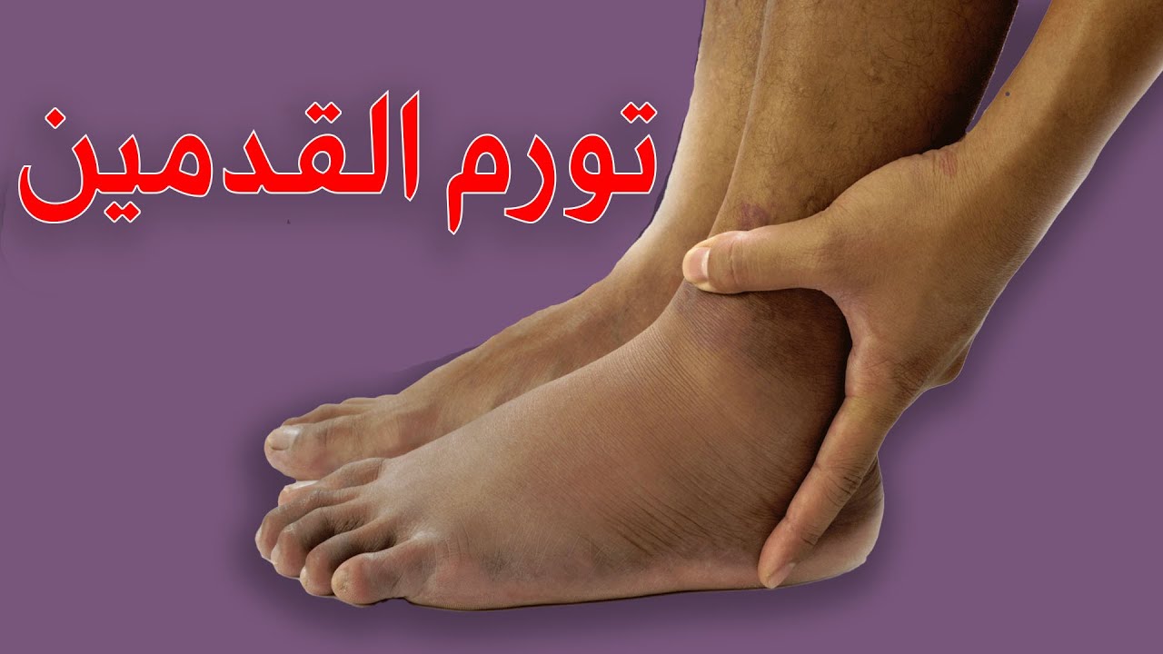 تورم القدمين الاسباب والعلاج/انتفاخ القدمين والساق