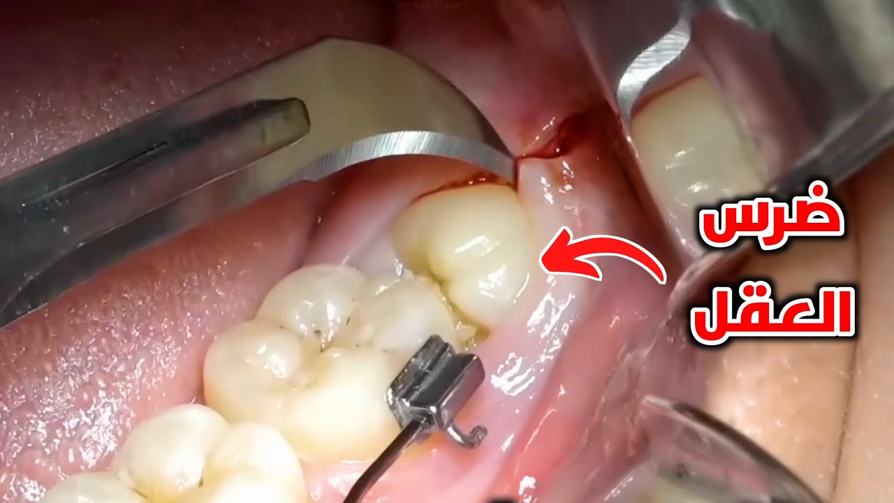 شاهد ازاي  بنخلع ضرس  العقل المغروس في اللحم _ واعرف معلومات كتيرة عنة _ wisdom tooth extraction
