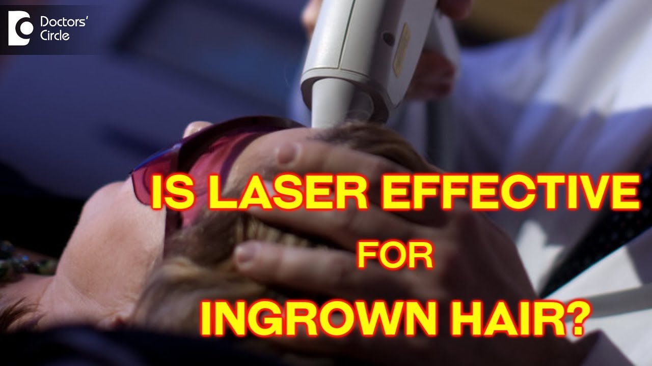 How effective is laser hair removal for ingrown hairs? - Dr. Rasya Dixit