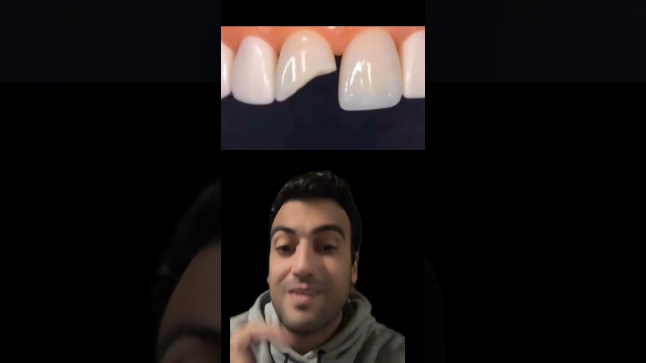 RESTAURAÇÃO DE RESINA EM DENTE ANTERIOR!