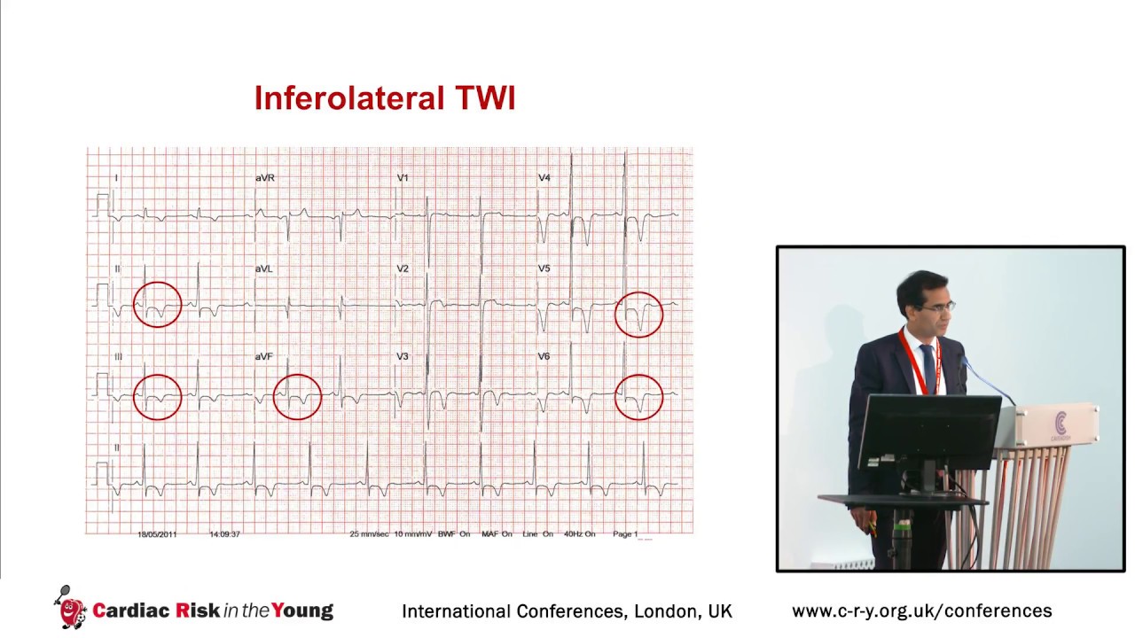 CRY Conference 2017 - ECG indices of cardiomyopathy - Dr Nabeel Sheikh