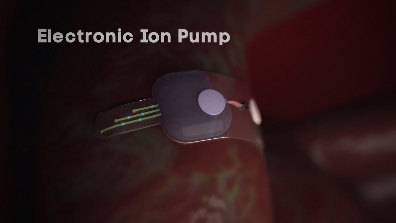 Future therapy with the electronic ion pump
