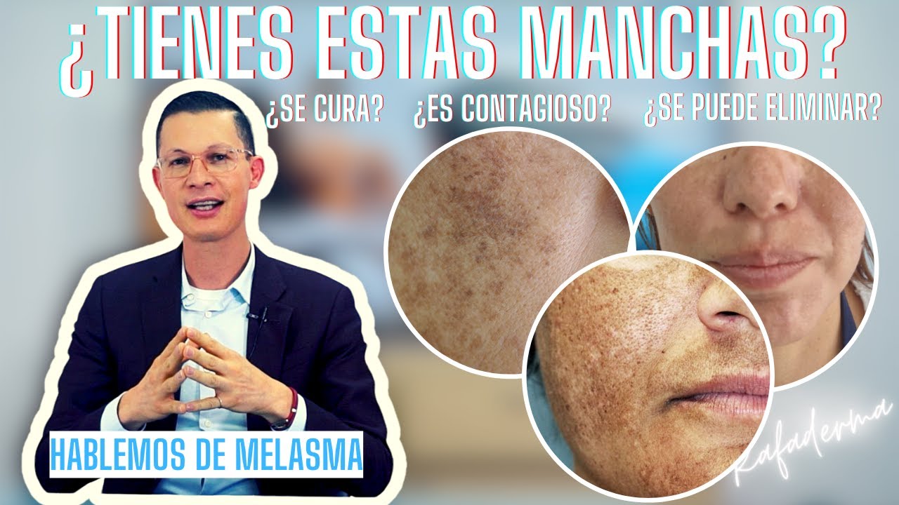 Hablemos de Melasma | Rafaderma