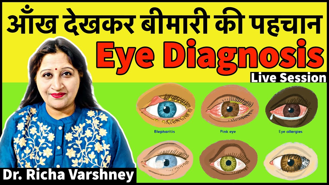 आँख देखकर बीमारी की पहचान - Eye Diagnosis - Acupressure Diagnosis Training - Live Session#28