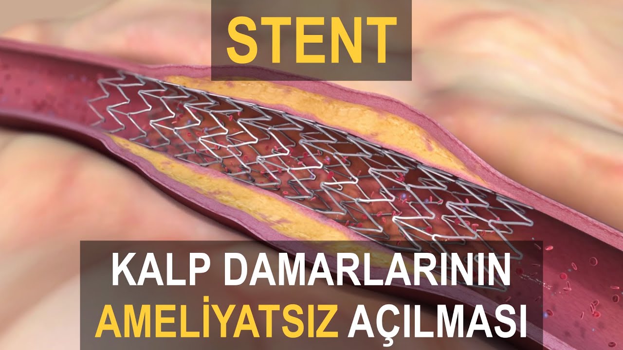 STENT NEDİR? | Stent Nasıl Takılır?