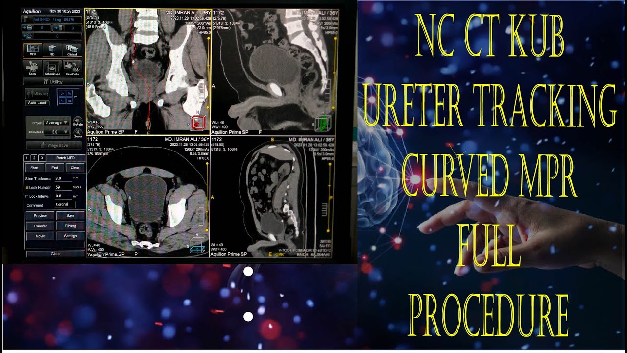 NON CONTRAST CT SCAN OF KUB FULL PROCEDUR WITH SCANING AND FILMING. #basicradiology