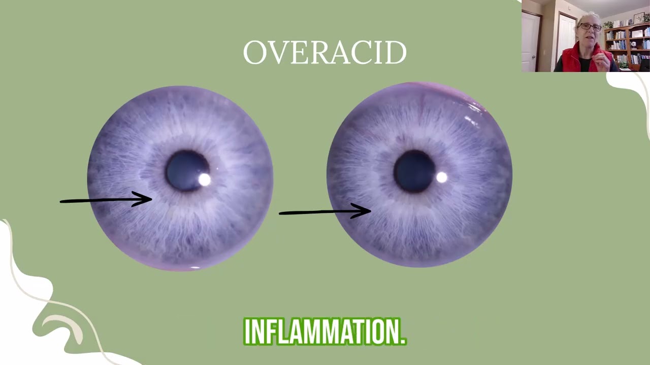 Intro to what other colors in an iris mean (constitutional sub-types)