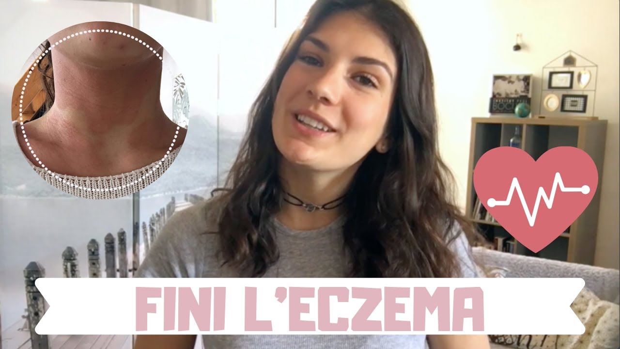 FINI L'ECZEMA // Mes conseils pour enfin s'en débarrasser
