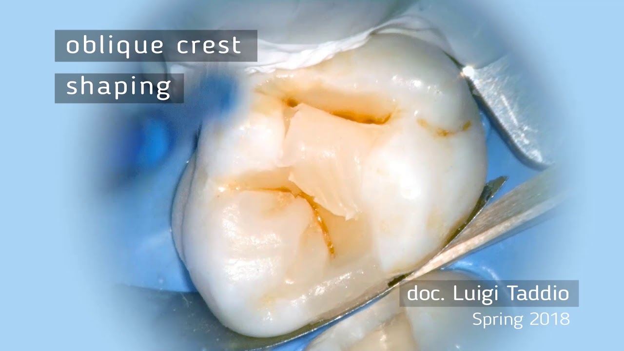 Dental Morphology Restauration - Luigi Taddio