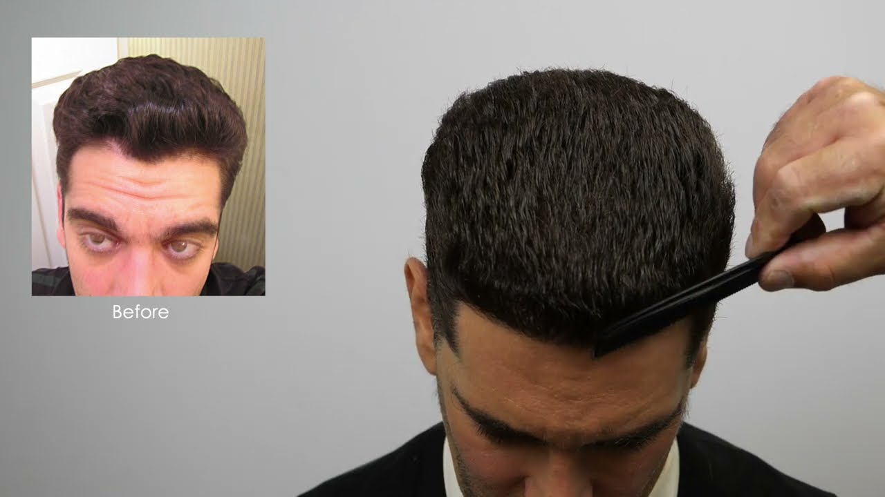 1500 Graft Hair Transplant Result