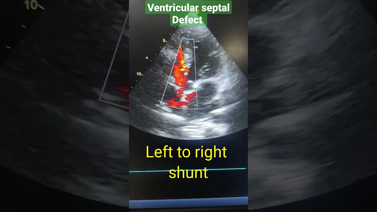 VSD (ventricular septal defect) in Echo, left to right shunt #youtubeshorts #shortsvideo #shorts