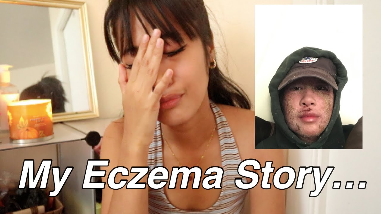 my TSW experience (topical steroid withdrawal, trying NMT, eczema, depression, healing)