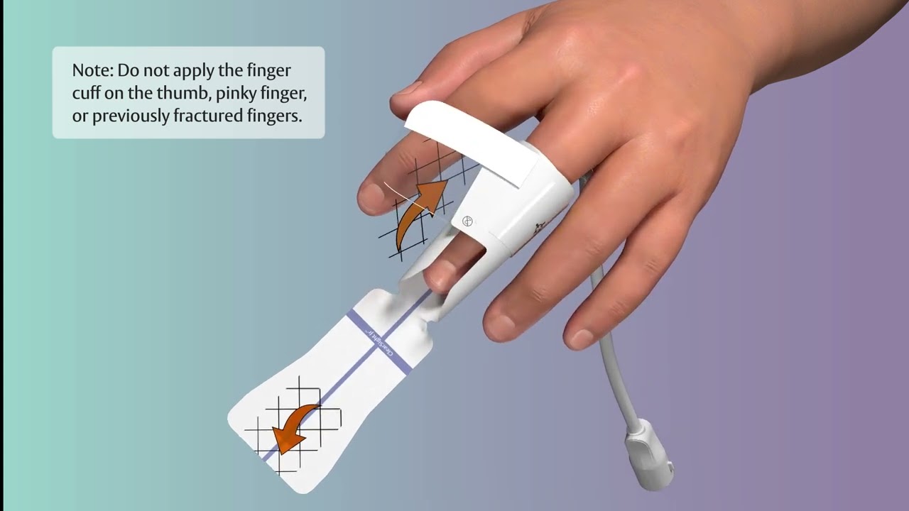 ClearSight Jr™ Finger Cuff Placement
