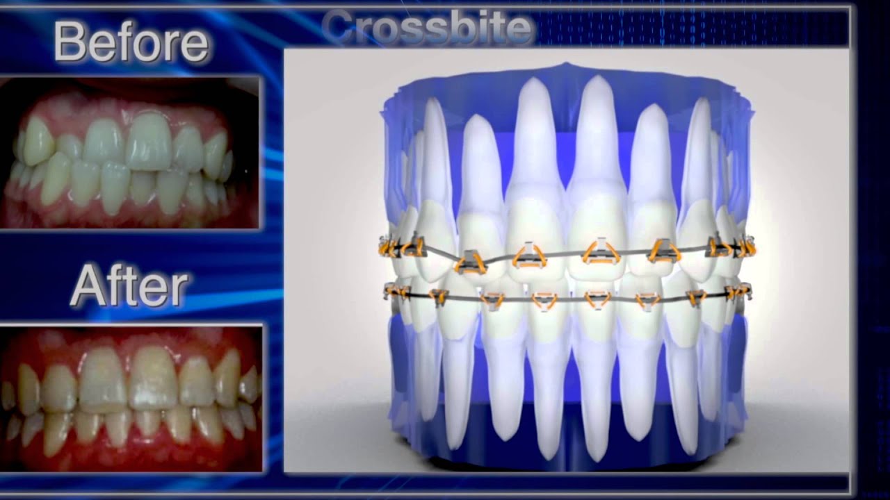 Fastbraces&reg; Before and After Gallery