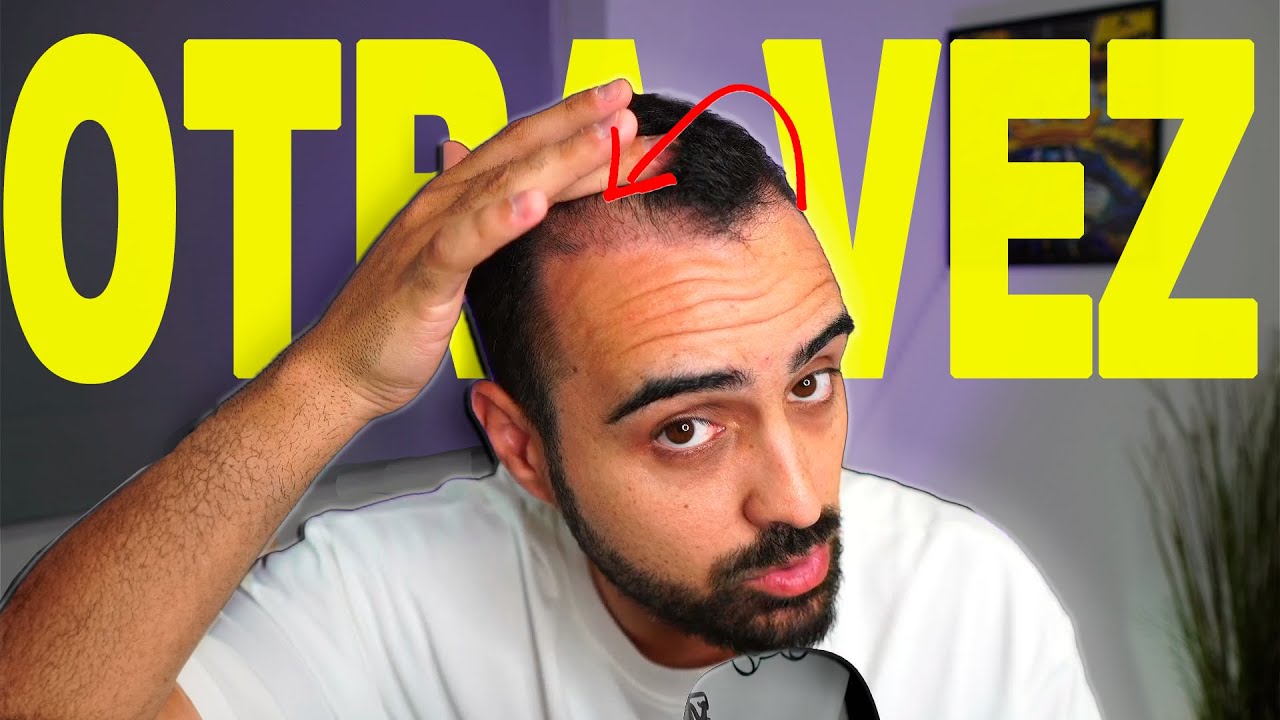 SHOCK LOSS después del injerto capilar | ¿Cuándo empieza? ¿Vuelve a salir? ¿Cómo solucionarlo?