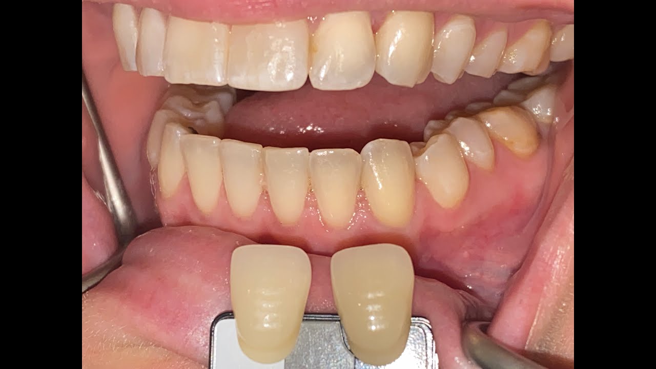 05 Dental Photography:  Retraction and Shooting the Correct Tooth