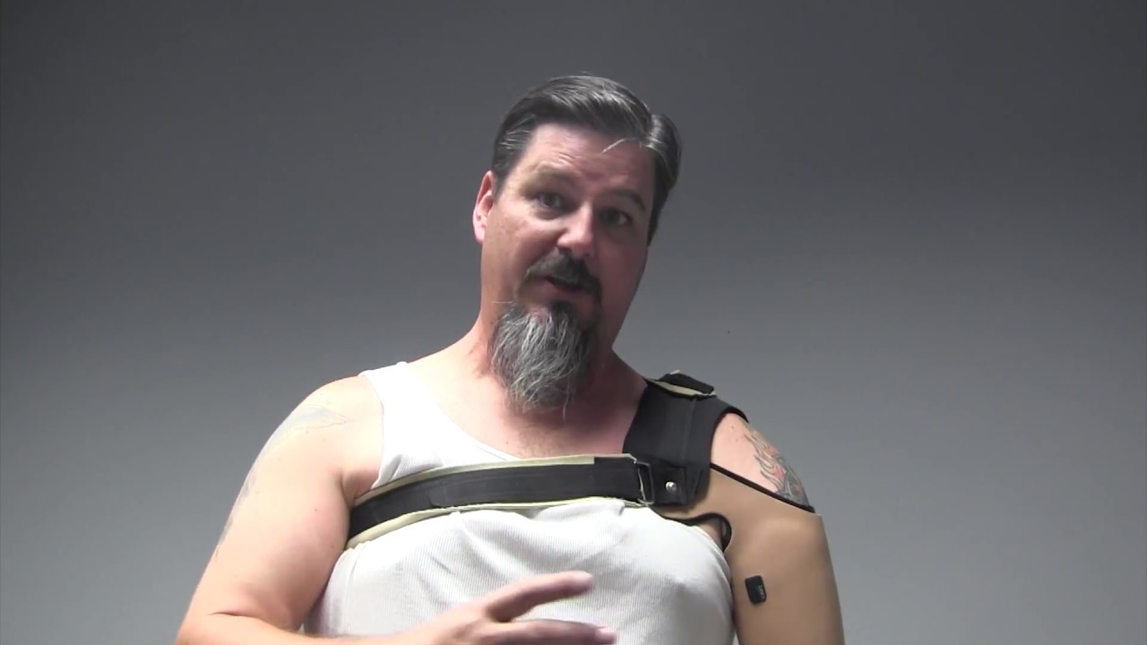Jason's Bionic Arm - HiFi Socket, COAPT, LTI Elbow, i-limb hand