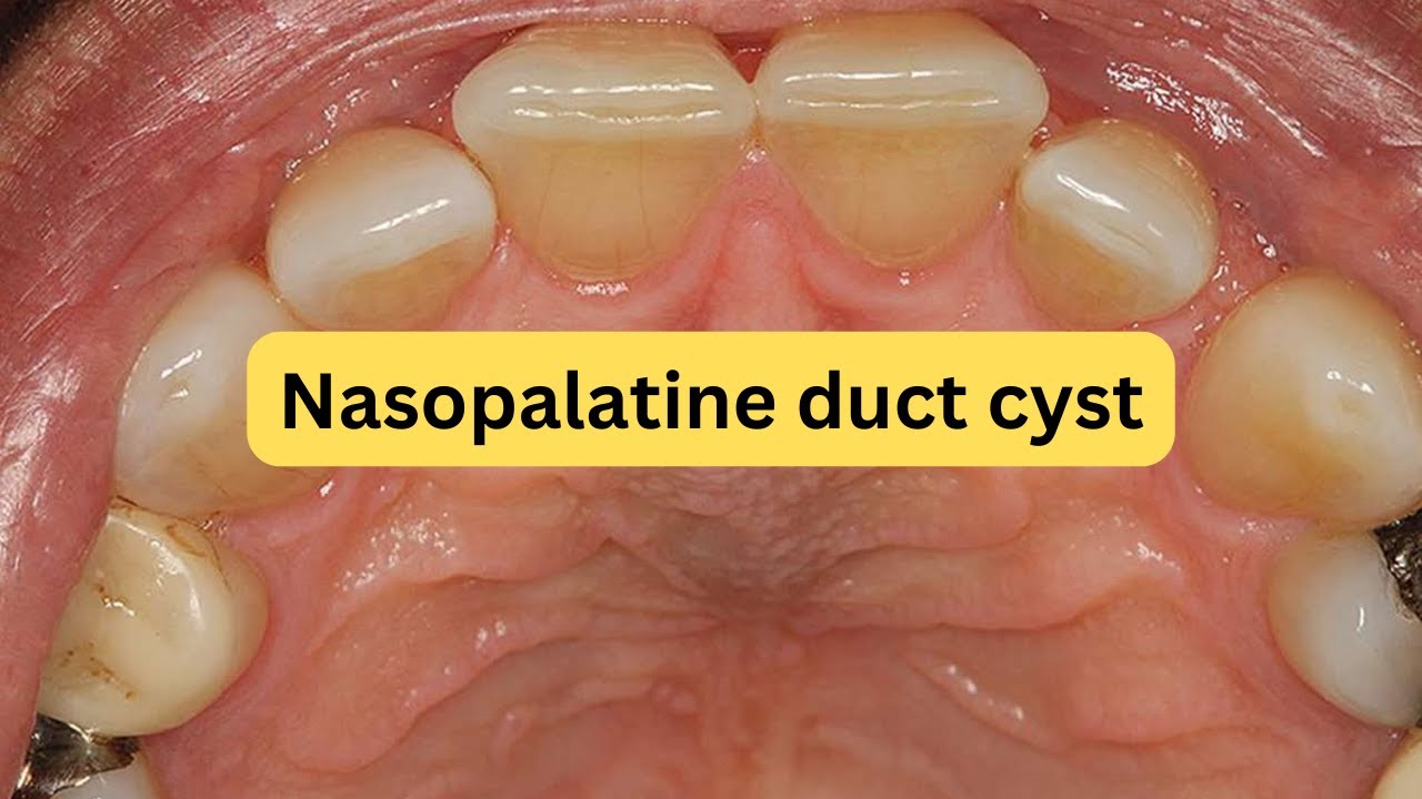What is nasopalatine duct cyst? EASY!!