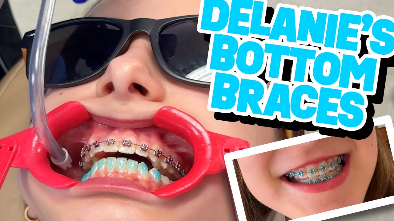 Delanie finally gets her bottom braces on!