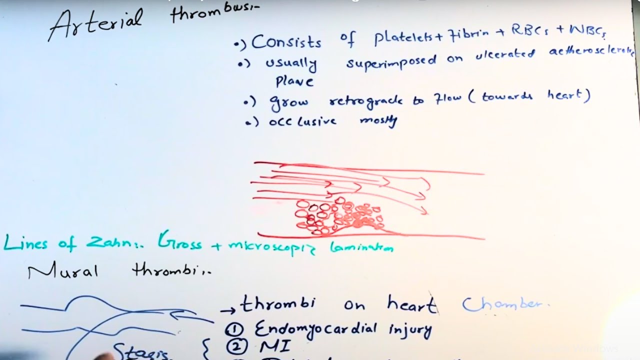 Arterial versus venous thrombosis |DVT| Mural thrombi and vegetations _medico stuff 2022
