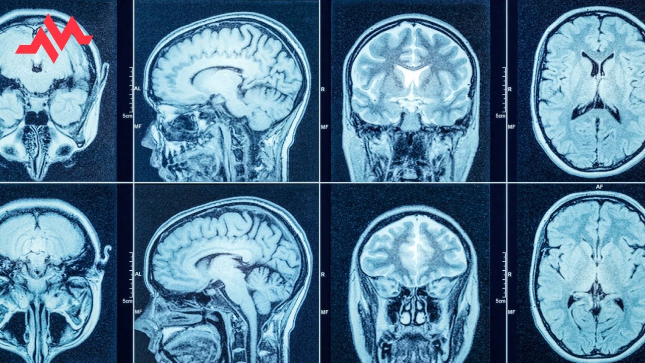 Headache for the last 4 months - Case Report
