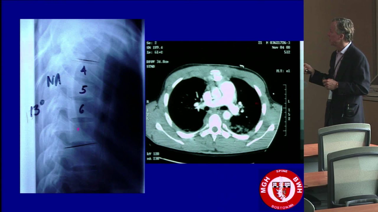 Treatment Decisions in Thoracolumbar Trauma: Operative or Non-operative? by Kirkham B. Wood, M.D.