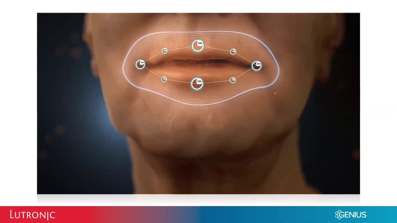 Volumization with Low Downtime: New Genius Lift Technique & Review Webinar