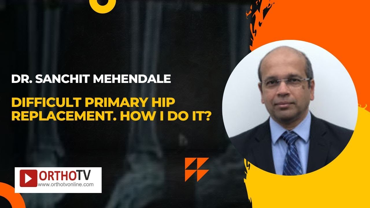 Difficult Primary Hip replacement. How I do it? Dr. Sanchit Mehendale, UK