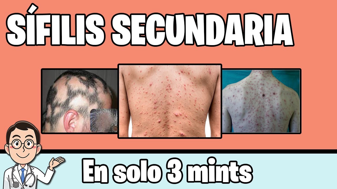 SÍFILIS SECUNDARIA Generalidades MANIFESTACIONES CLINICAS | BIEN EXPLICADO