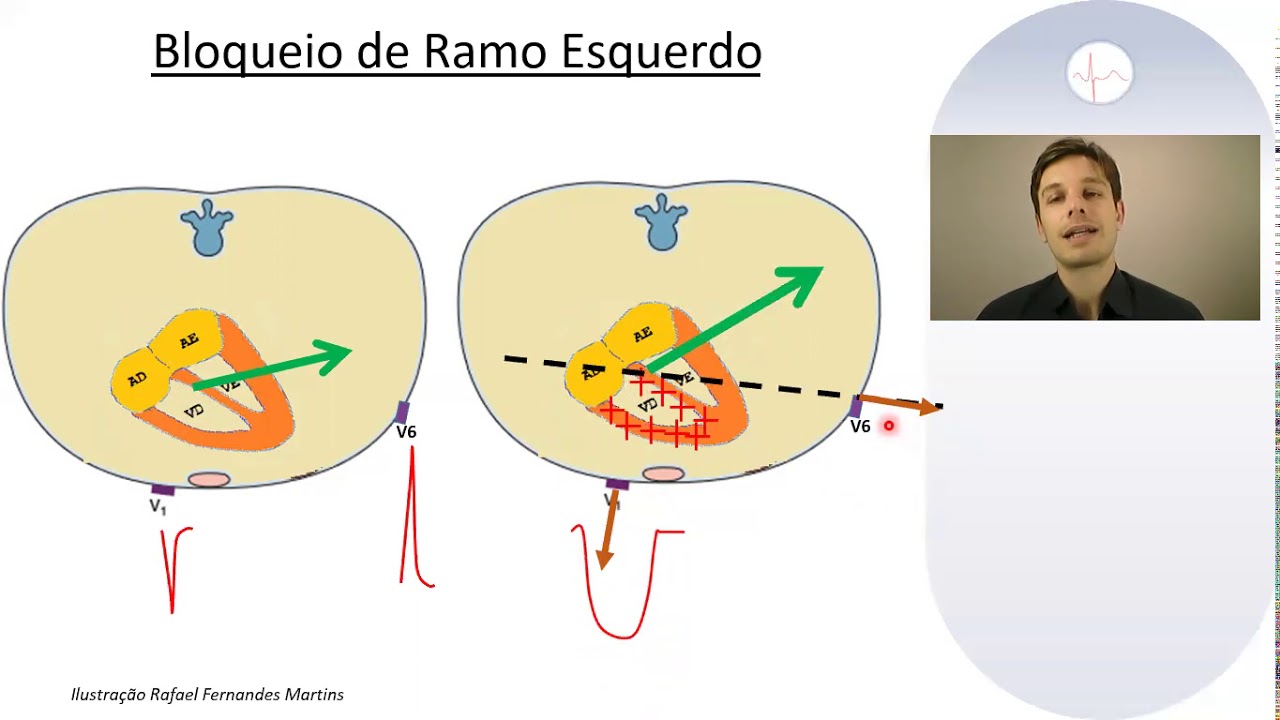 Descomplicando o ECG: 7 - Patologias do QRS, Bloqueios de Ramo
