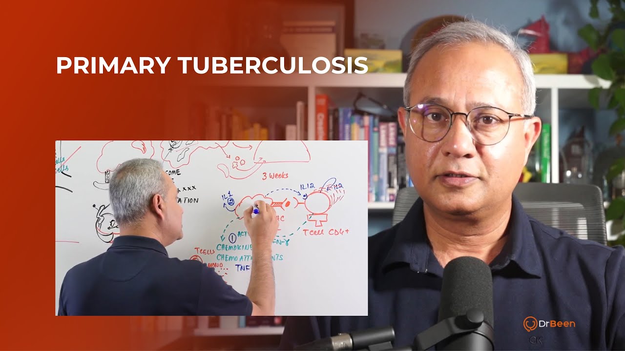 Primary Tuberculosis