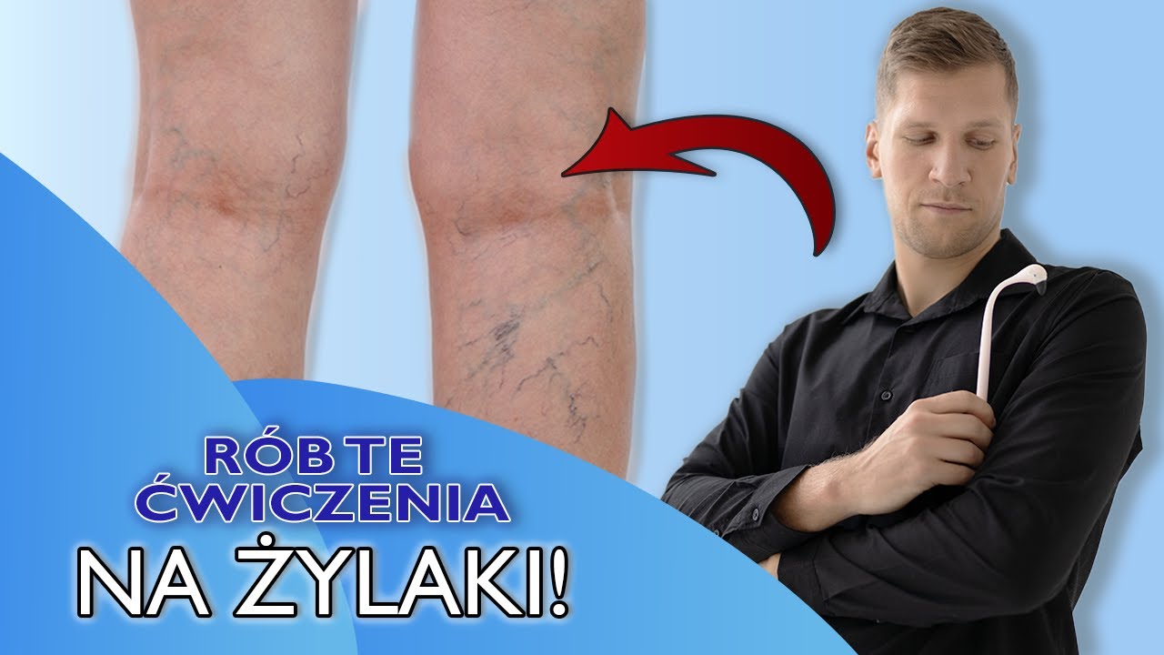 SKĄD SIĘ BIORĄ ŻYLAKI I JAK SIĘ ICH POZBYĆ?