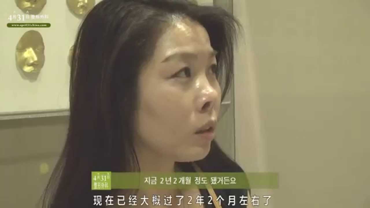 Best Korean Rhinoplasty / April31 Plastic Surgery - Revision Rhinoplasty - Before & After