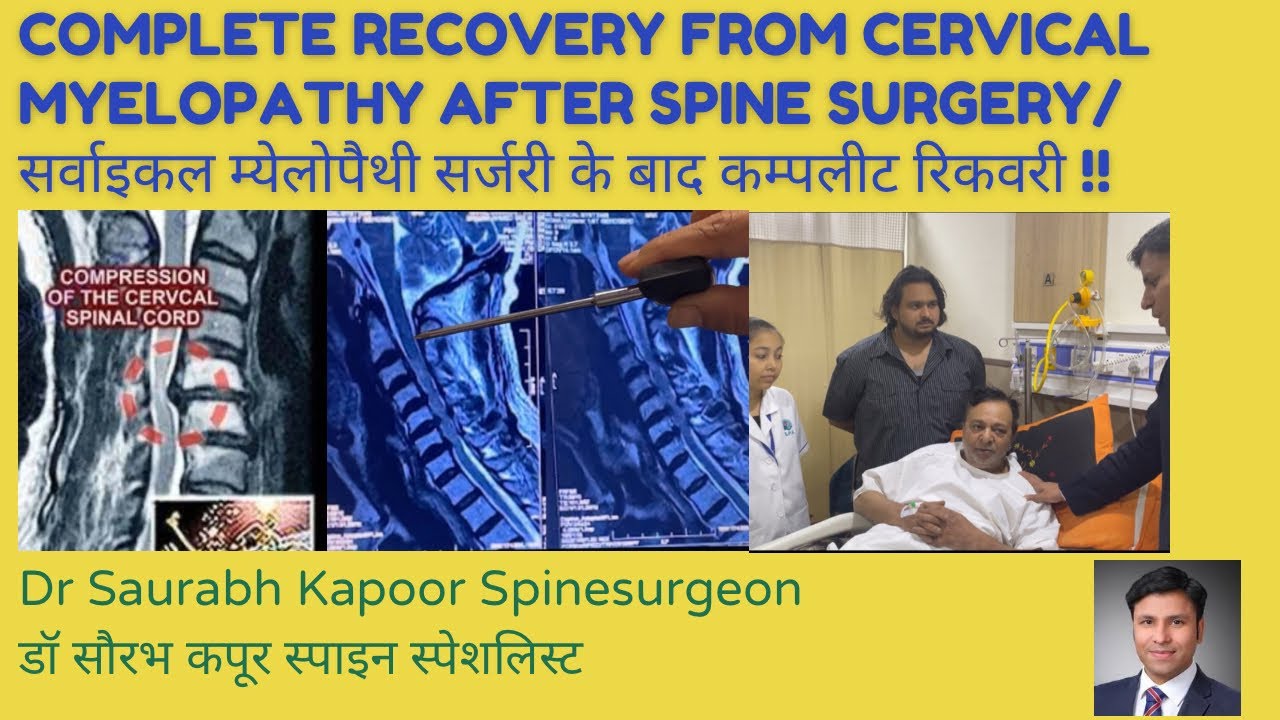 Complete recovery from cervical myelopathy after spine surgery- Dr Saurabh Kapoor bestspinesurgeon