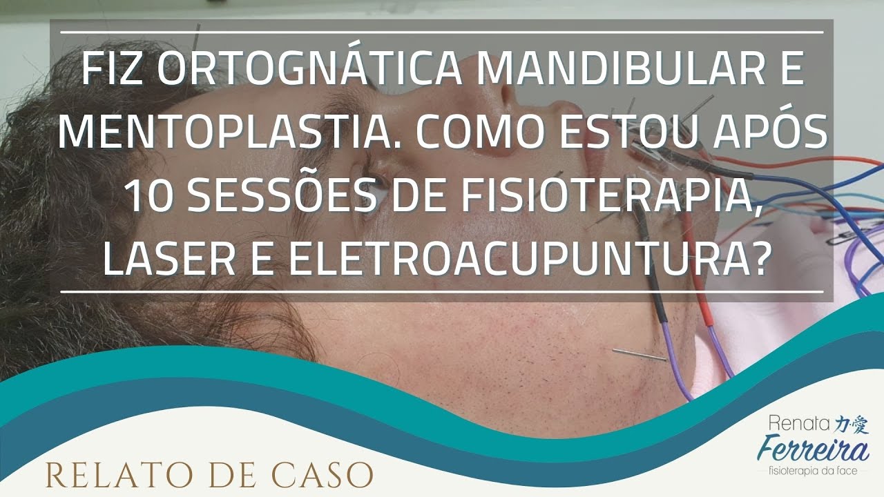 Fiz ortogn&aacute;tica e mentoplastia. Como estou ap&oacute;s 10 sess&otilde;es de fisio, laser/eletroacupuntura
