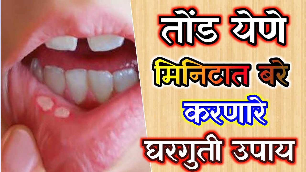 तोंड येणे मिनिटात आराम घरगुती उपाय, tond yene gharguti upay in marathi, mouth ulcer home remedy