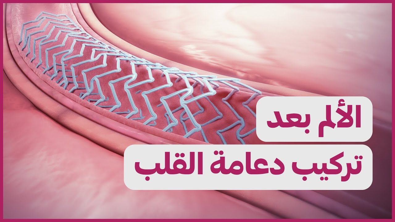 Pain after stent | الألم بعد تركيب دعامة القلب