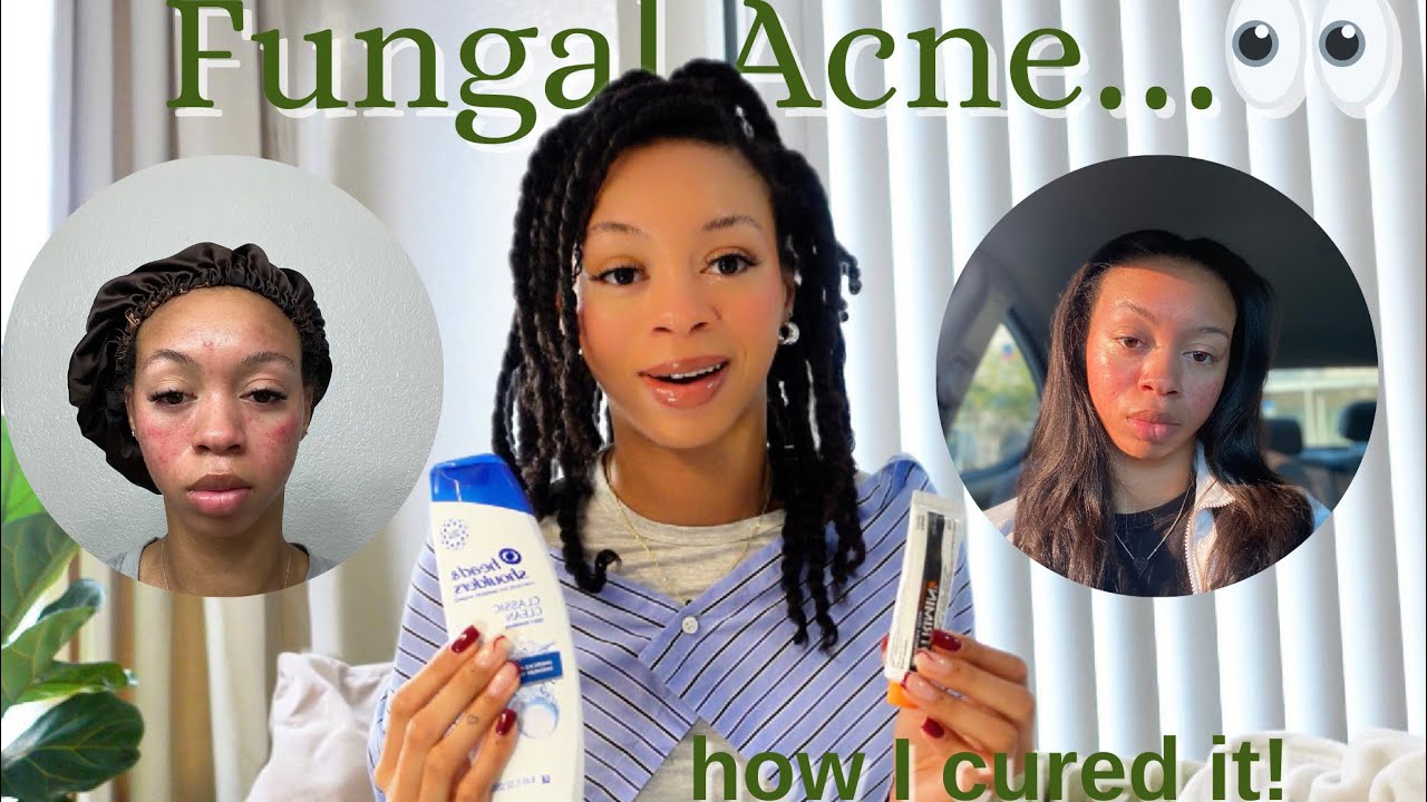 I Cured My FUNGAL ACNE in 30 Days! | Head & Shoulders