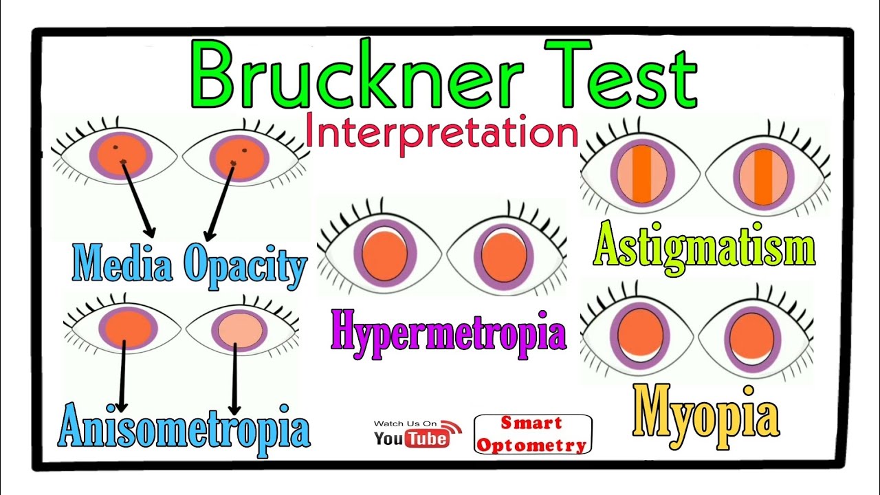Interpretation of Bruckner Test