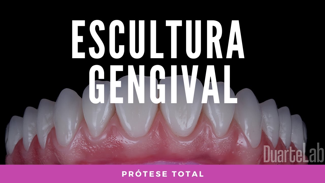 Escultura gengival caracterizada em Prótese Total