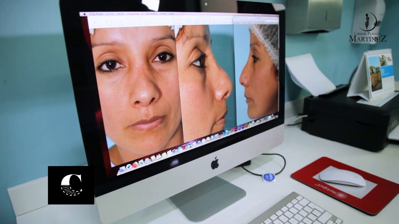 RINOPLASTIA SECUNDARIA| REALITY CAMBIOS | Cirugía Plástica Martinez