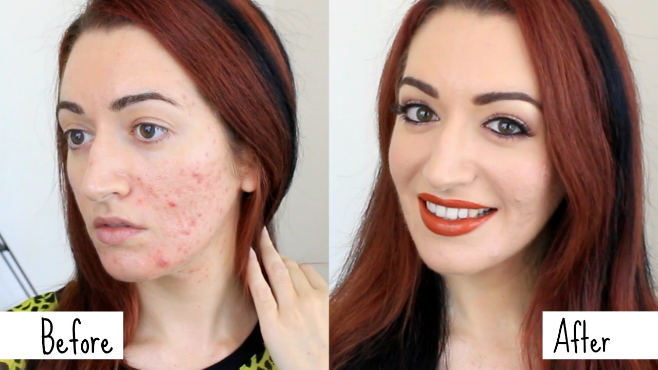 Easy Acne & Scarring Coverage GRWM // How To Cover Acne Makeup Transformation