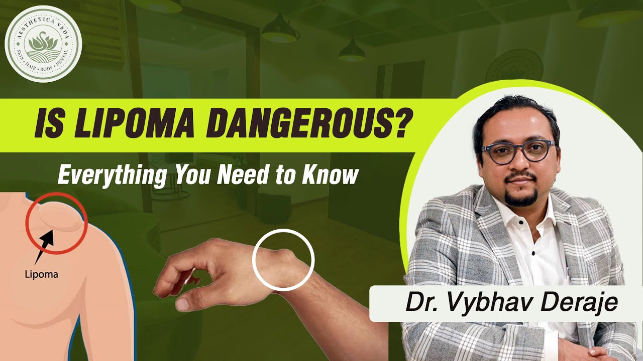 Lipoma Explained When to Worry & When to Ignore It? - Dr. Vybhav Deraje | Aesthetica Veda