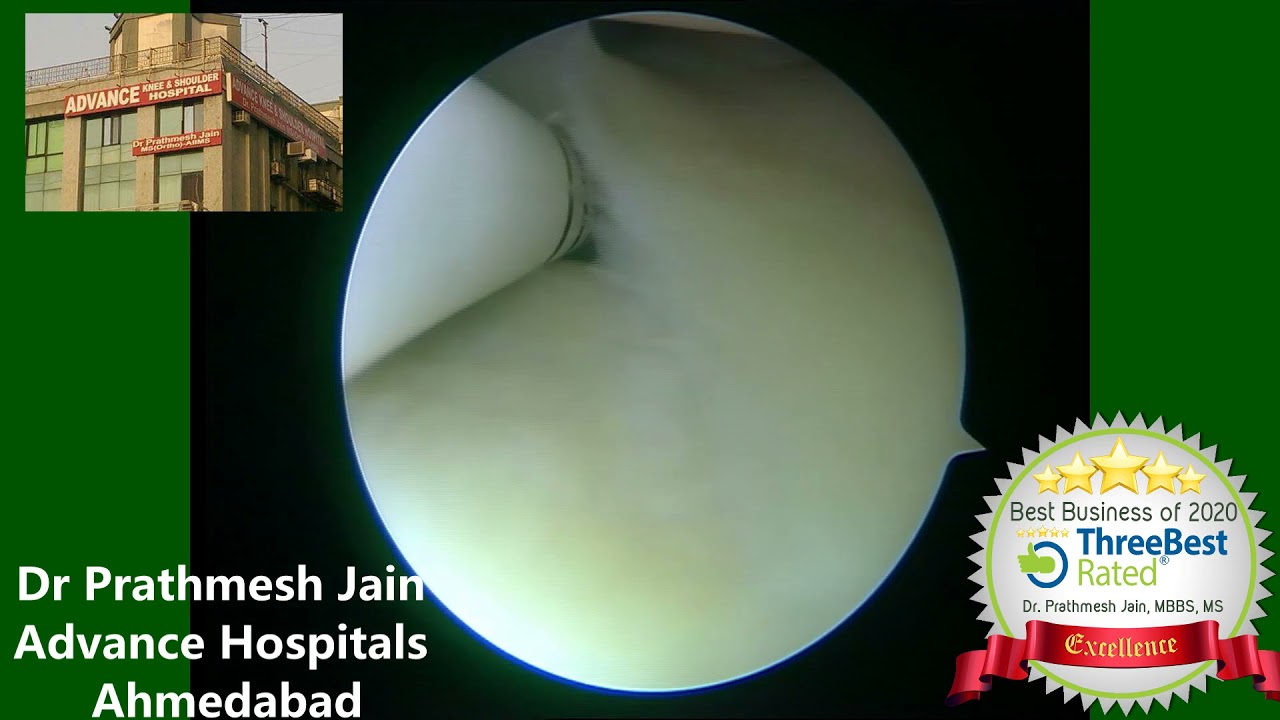 Lateral Meniscus Undersurface Repair With AIR device