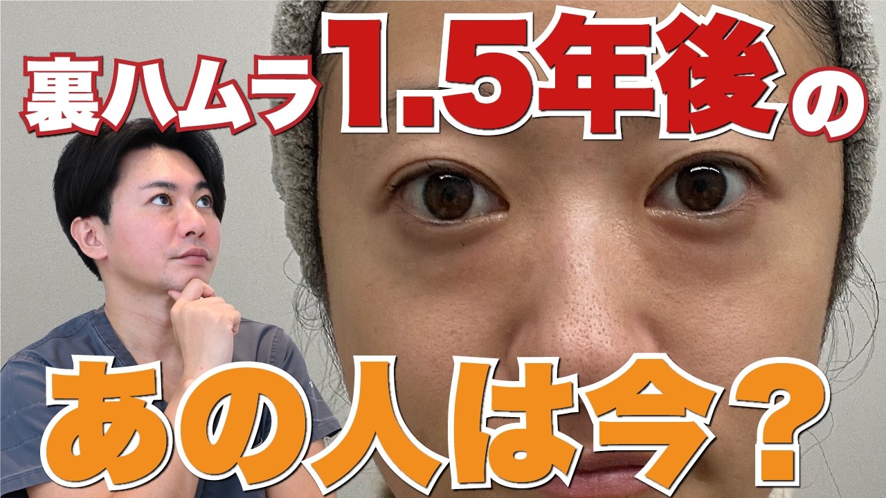 裏ハムラ再発？クマ取りから1.5年後のリアルな感想インタビュー【美容/整形/ダウンタイム】