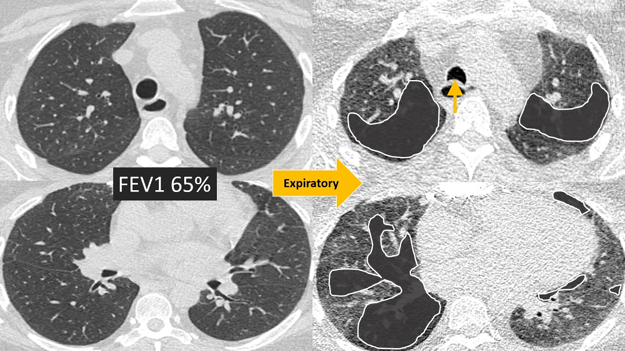 Understanding Bronchiolitis