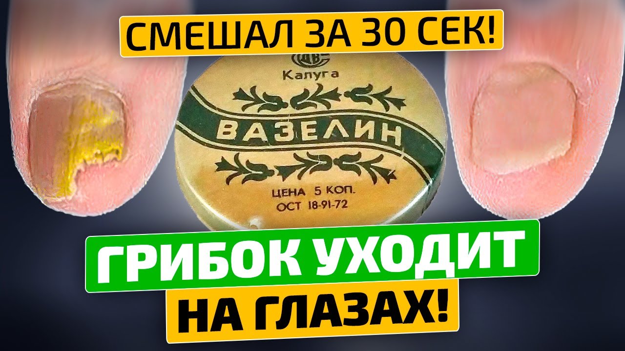 Грибок исчез! Кто придумал мешать вазелин с ...? За 2 раза помогло!